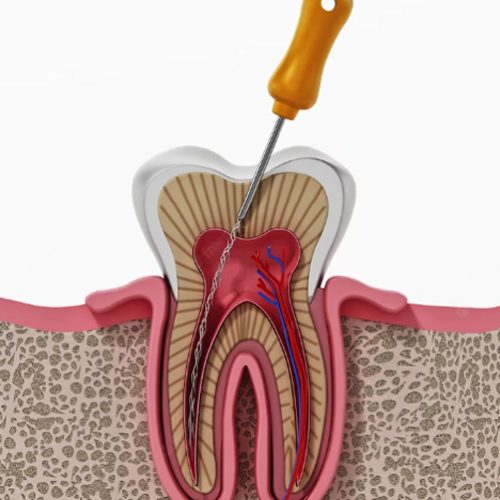 Root Canal Treatment Sevenoaks, kent
